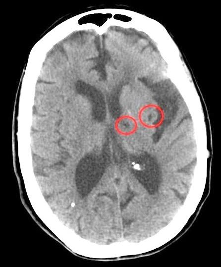 File:CT of lacunar strokes.jpg