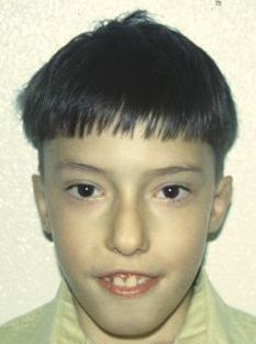 File:DiGeorge syndrome2.jpg