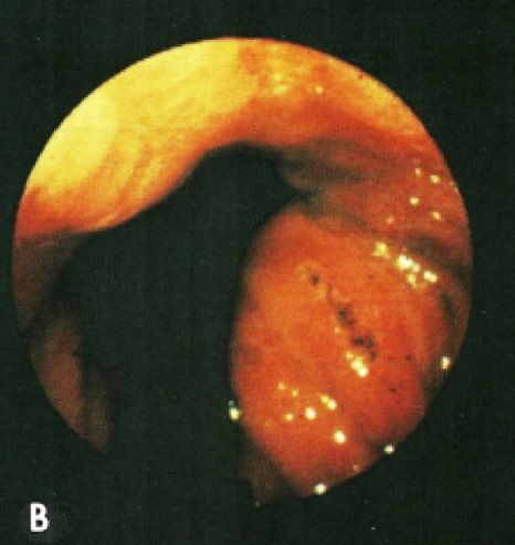 File:Cameron lesions wiki (photos only)-2B.jpg