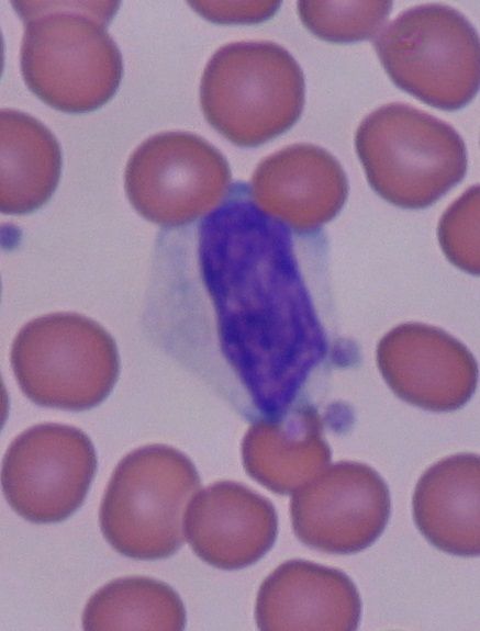 File:Reactive lymphocyte closeup.JPG