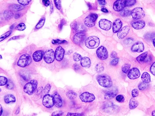 File:Thyroid papillary carcinoma histopathology (4).jpg