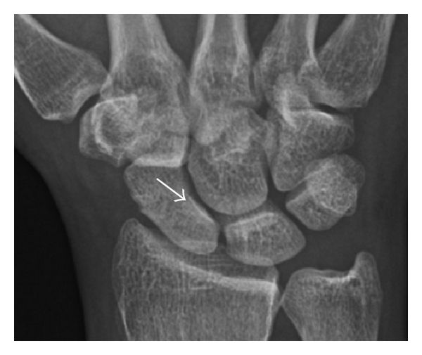 File:X-ray of subtle scaphoid fracture.jpg