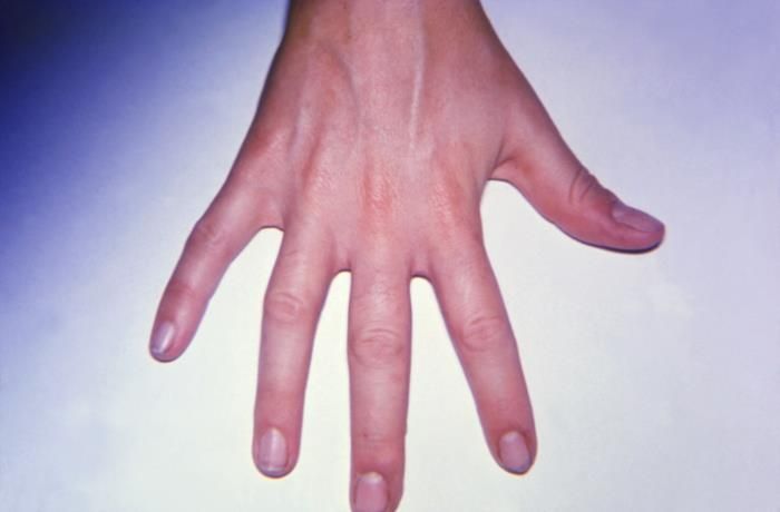 File:Arthritis on the Right Hand.jpg