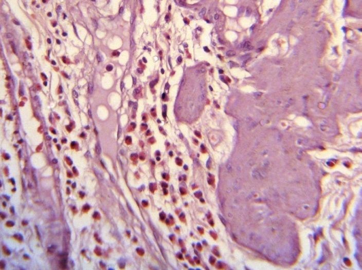 File:Histopathology of eosinophilic cholecystitis.jpg