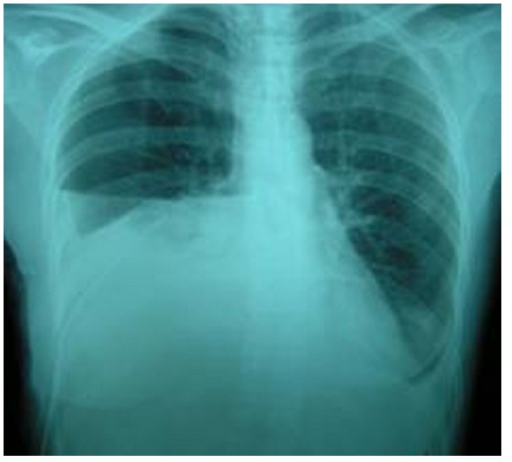 File:Pleural effusion caused by urinothorax.png