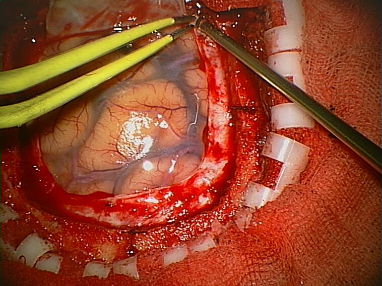 File:Craniotomy Arachnoid.jpg