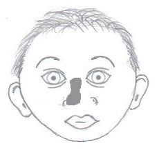 File:Nasal dysplasia.jpg