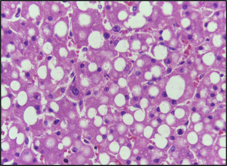 File:Fatty change liver - Lipid steatosis 40X.jpg