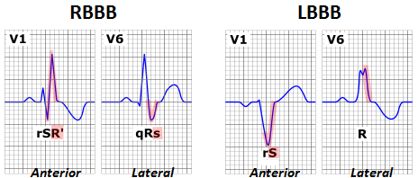 File:Left and right bundle branch block.png