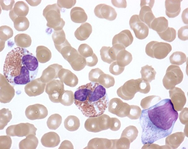 File:Activated Eosinophils in Idiopathic Hypereosinophilic Syndrome (9125007255).jpg