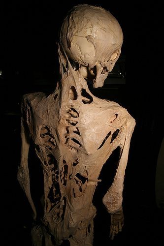 File:Fibrodysplasia ossificans progressiva.jpg