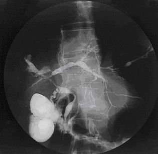 File:Cholangiogram of primary sclerosing cholangitis.jpg