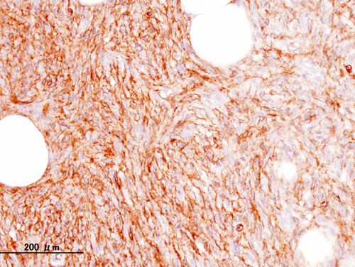 File:Dermatofibrosarcoma protuberans (5) CD34.JPG