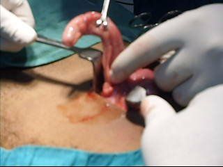 File:Inflamed appendix.jpg