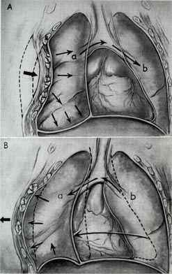 File:Flail chest mechaincs.jpg