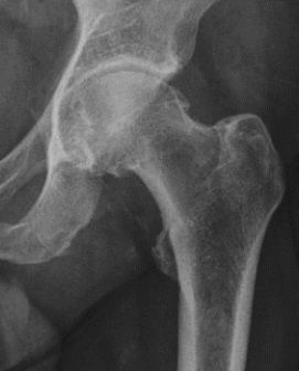 File:X-ray of pincer impingement.jpg