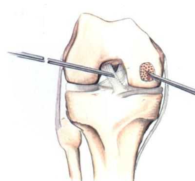 File:Paste Graft Surgery-1.jpg