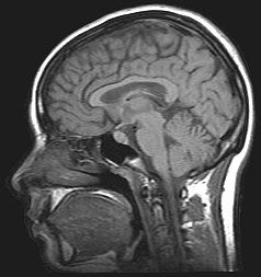 File:MRI brain.jpg