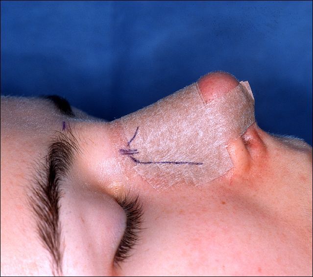 File:RhinoplastySplint2.jpg