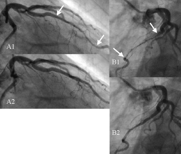 File:Myocardial bridges.jpg