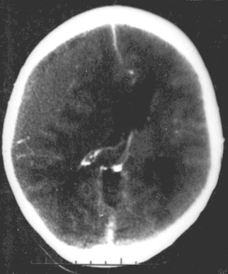 File:Epidural hematoma.png