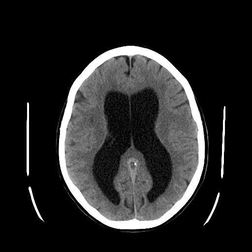 File:Hydrocephalus.jpg