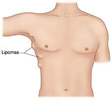 File:Lipoma illness.jpg