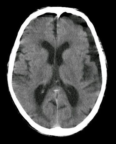 File:Subdural hygroma, frontal and temporal.jpg