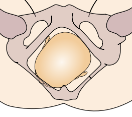 File:Cephalic presentation - left occipito-anterior.png