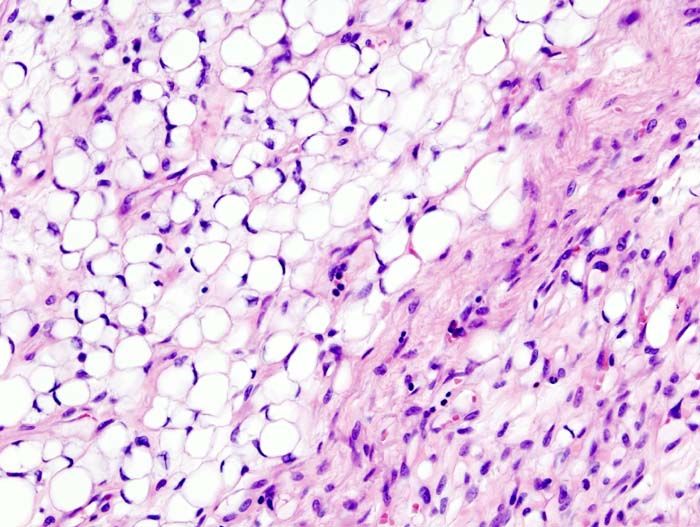 File:Myxoid liposarcoma (01).jpg