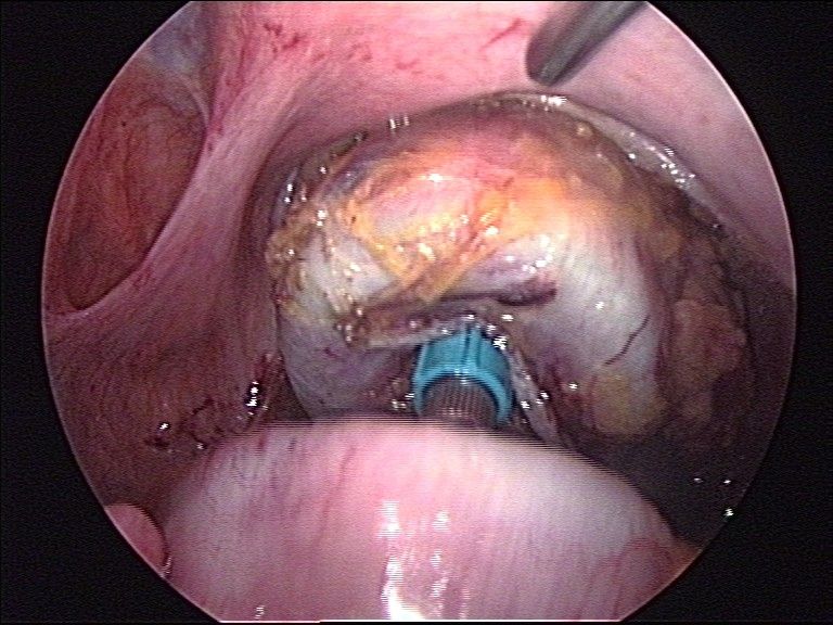 File:Stapler anastomosis of sigma (laparoscopic) 4.jpg