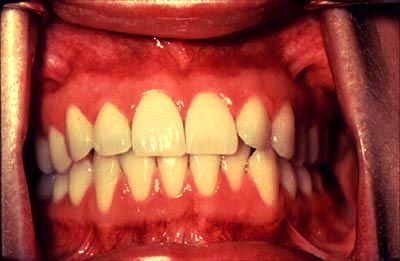 File:NIH DOC 7 gingiva.jpg