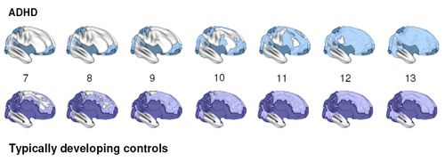 File:Adhd brain timelapse.jpg