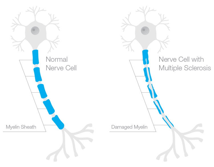 File:Myelin sheath damage in multiple sclerosis.png