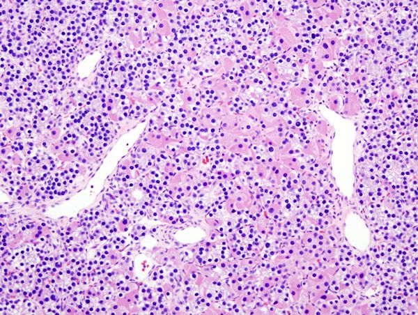 File:Parathyroid adenoma histopathology (1).jpg