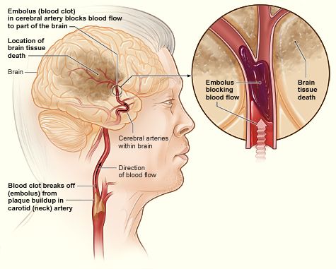 File:Stroke ischemic.jpg