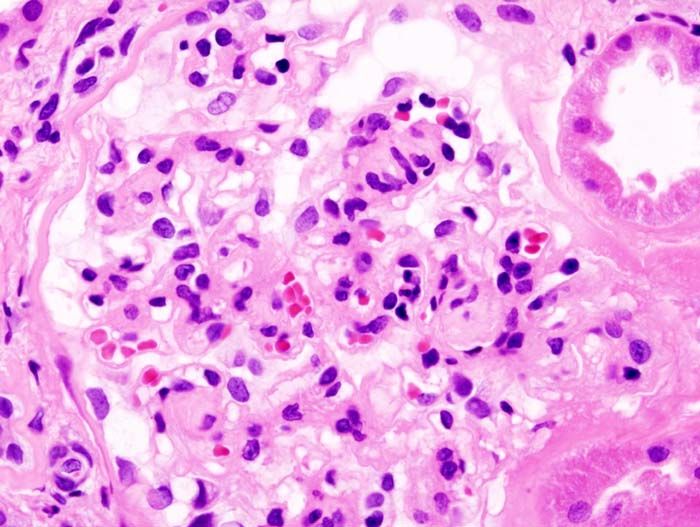 File:Diabetic glomerulosclerosis (3) HE.jpg