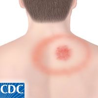 A computer-generated photo of the back of a white individuals upper abdomen is shown, near their right shoulder blade there is a red rash. The rash consists of a completely red dot and then a red outline of a circle around it, resembling a bullseye.