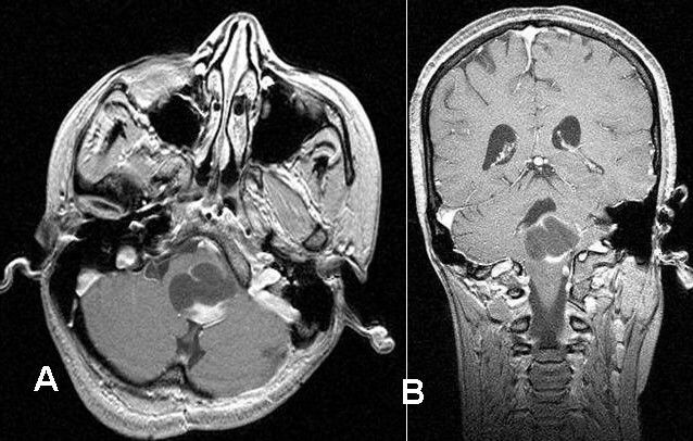 File:Pilocytic.jpg