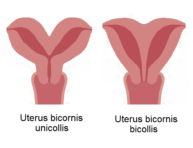 File:Uterus bicornis 1.png