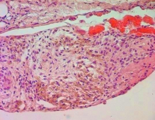 File:Siderophages in endometriotic focus.jpg