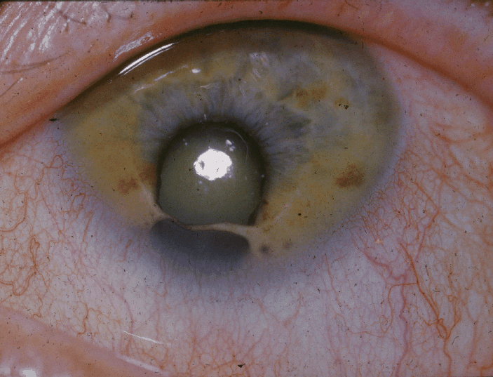 File:Coloboma-2.png