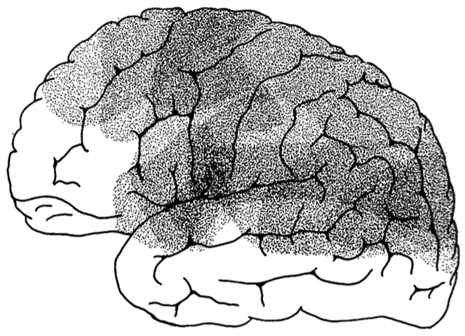 File:Isotope Localization of Infarcts in Aphasia.png