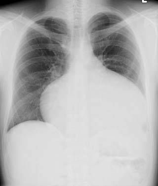 File:ASD Chest X-Ray.jpg