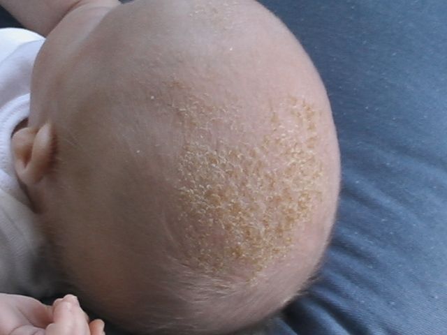 File:Baby With Cradle Cap.jpg