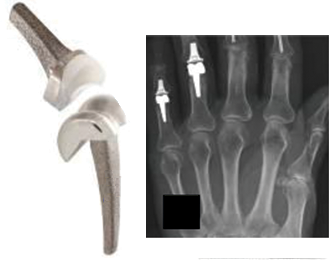 File:Finger joint replacement prosthesis.png