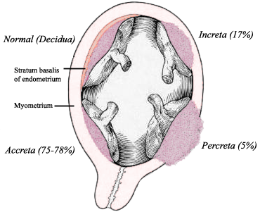 File:Placenta accreta.png