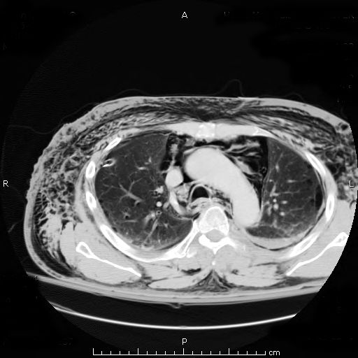 File:Subcutaneous emphysema chest.jpg