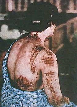 File:Hiroshima burn marks.jpg