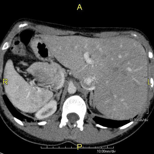 File:Primary ciliary dyskinesia 7.jpg